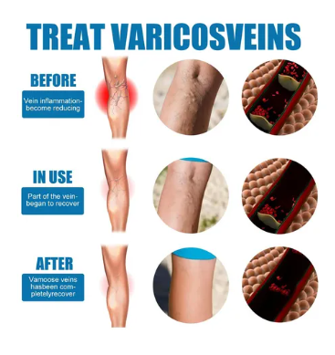 SPRAY DE TRATAMIENTO DE VARICES - Veinhealing